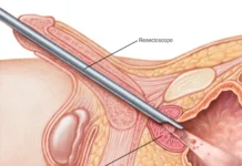 Medicamento ou cirurgia? Os novos caminhos para tratar o crescimento da próstata