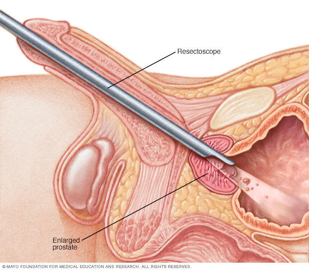 Resseccao-Endoscopica-da-Prostata-RTU